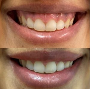 Quais Os Procedimentos Mais Usados Para Corrigir O Sorriso Gengival