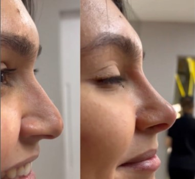 A harmonização facial vai realçar a sua beleza ⋆ Dra. Luana Rocha